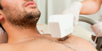 Triệt lông vĩnh viễn ở đâu tốt dành riêng cho đàn ông? - Cà phê học thuật